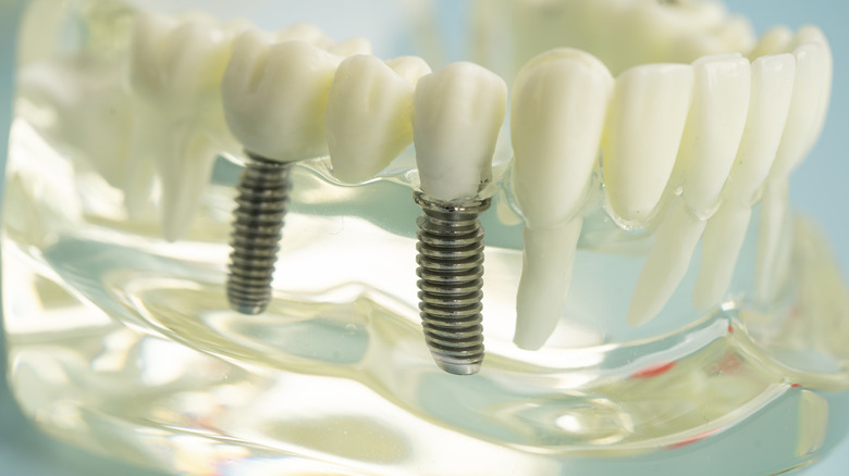 transparent model of lower jawbone showing metal posts for dental implants