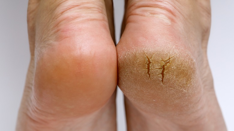 close up of bottoms of feet