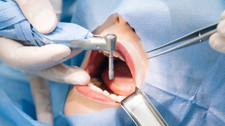 oral surgery being performed